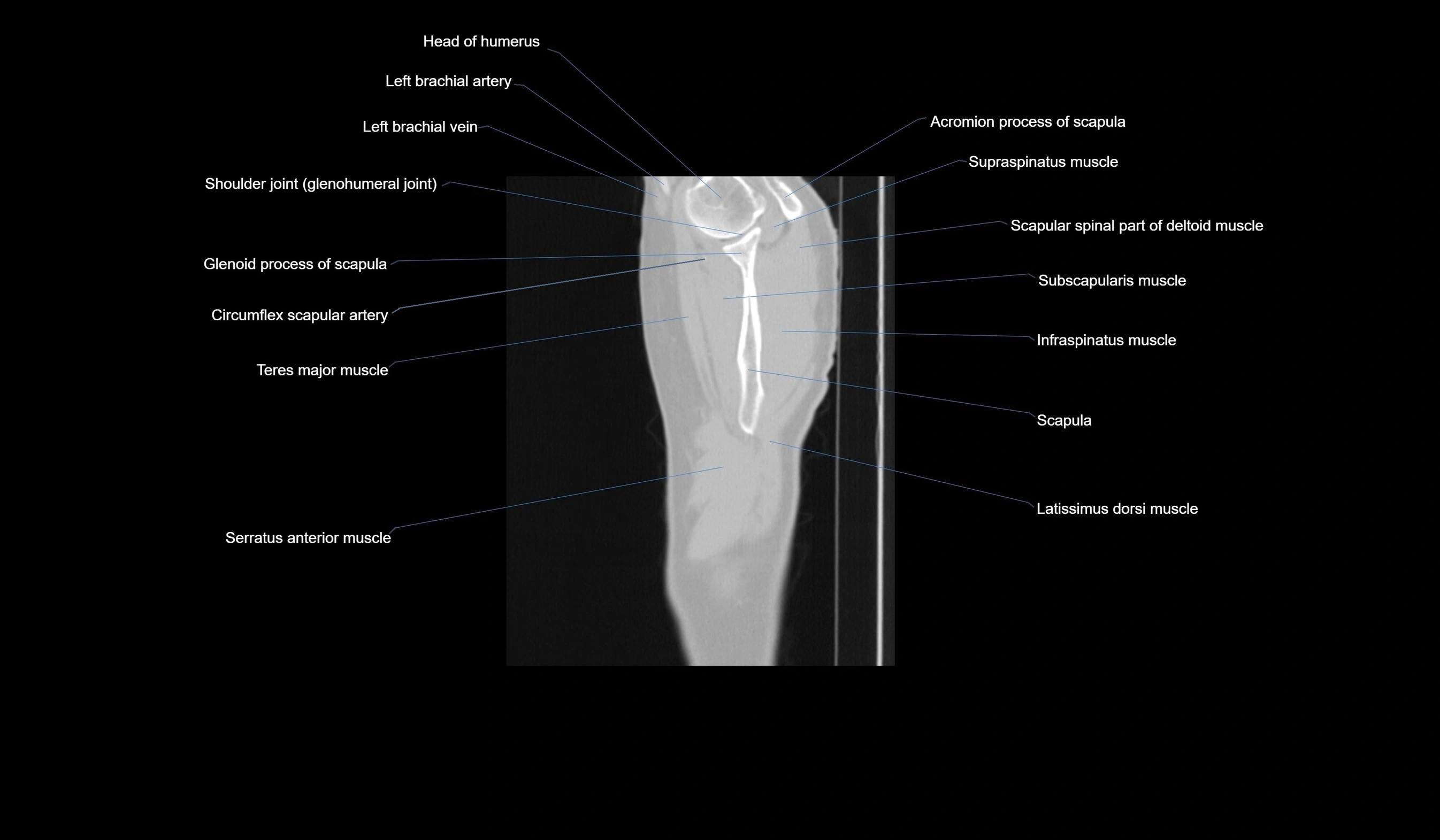 CT chest (thorax) lung window labelled sagittal cross sectional anatomy radiology image-00138.webp